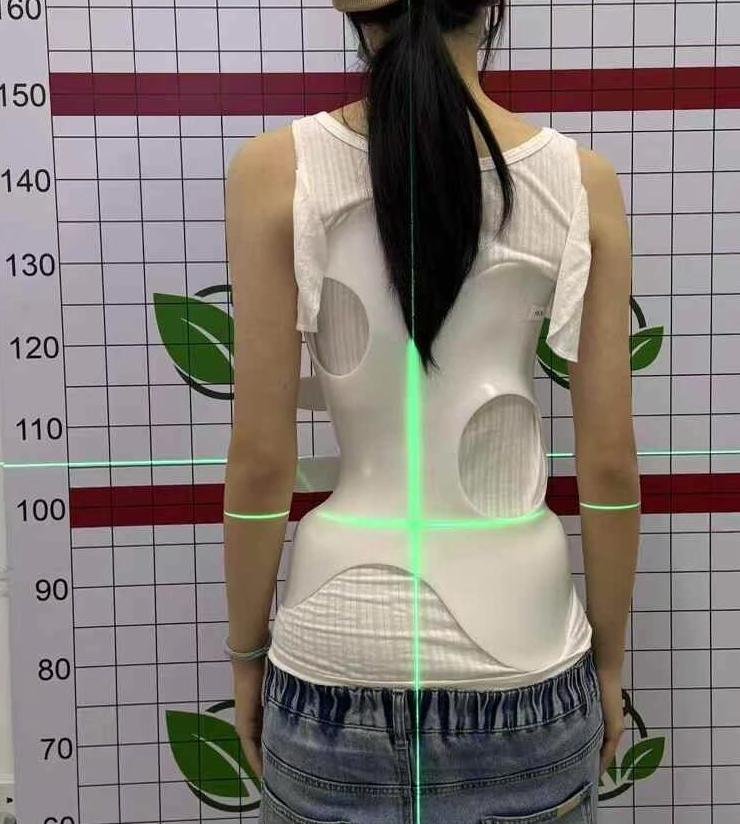 脊柱側彎穿戴