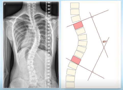 脊柱側(cè)彎的角度測量
