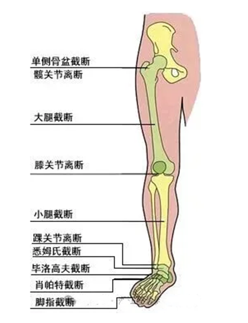下肢截肢部位名稱(chēng)