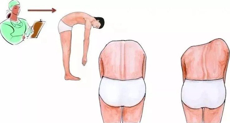 脊柱側(cè)彎早發(fā)現(xiàn)，早治療