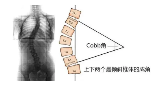 脊柱側(cè)彎角度怎么測(cè)量？