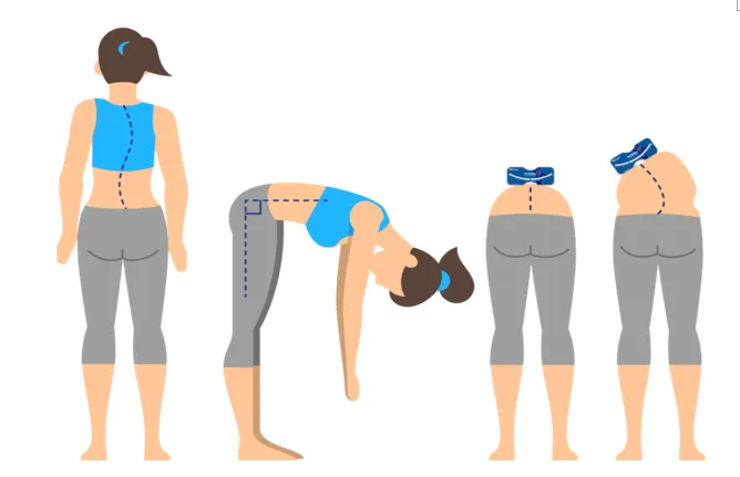 脊柱側(cè)彎支具穿戴3個月要及時復(fù)查