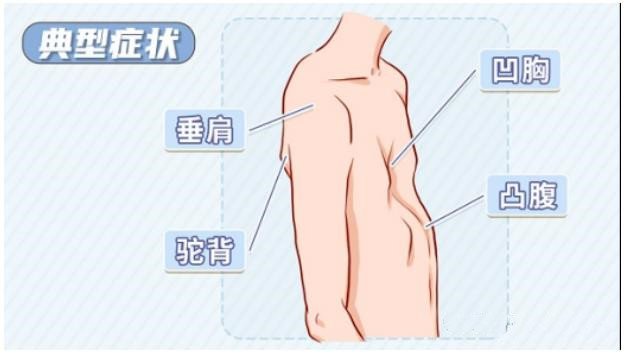 漏斗胸怎么矯正？