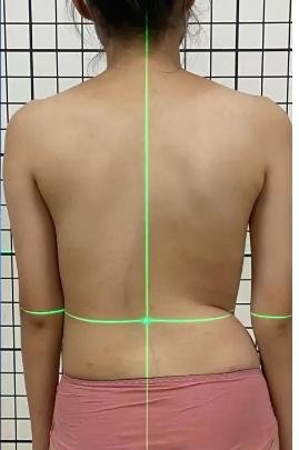 睡姿對(duì)脊柱側(cè)彎患者的影響